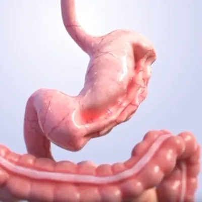 Gastroplastia Endoscópica