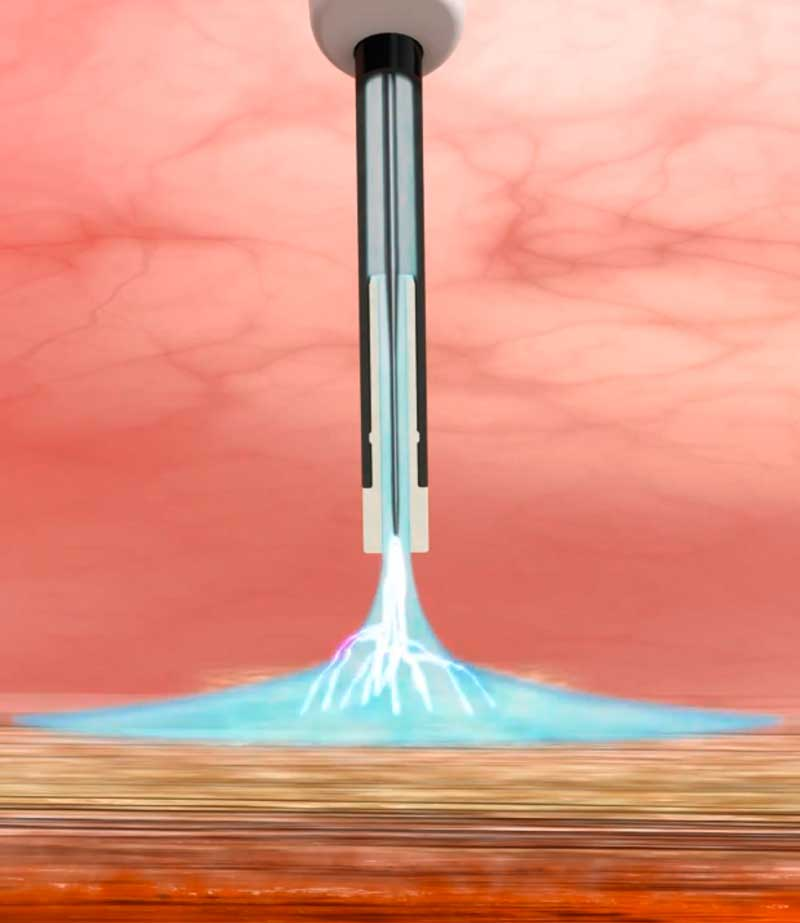 Tratamento para Reganho de Peso com Plasma de Argônio