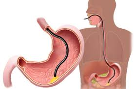 Endoscopia Digestiva Alta